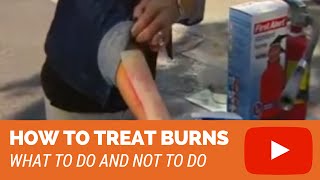 How to treat a first degree minor burn [upl. by Eitac]