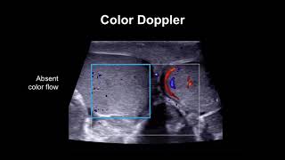 Diagnosing testicular torsion [upl. by Rus]