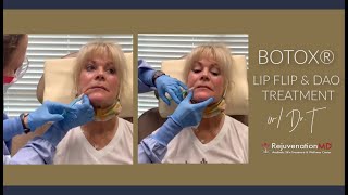 Lip Flip amp DAO Treatment with Botox® [upl. by Nosirrag510]