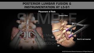 Posterior Lumbar Fusion amp Instrumentation at L5S1 [upl. by Irrot]