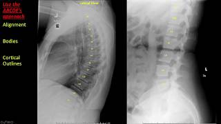 Introduction to Spine Radiographs [upl. by Asiram]