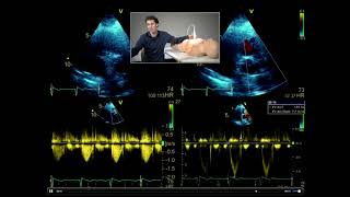 How to perform a full comprehensive transthoracic echo study [upl. by Ayatan]