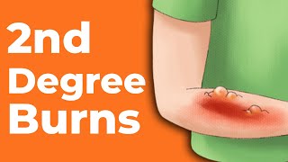 How To Treat Burns 2nd degree 3rd degree burns [upl. by Richmound]