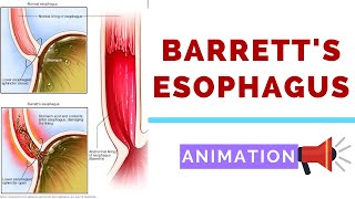 Barretts Esophagus  Pathology Dysplasia and Carcinoma [upl. by Aeniah]