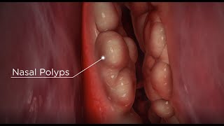 Nasal Packing for Severe Nosebleeds [upl. by Genesia911]