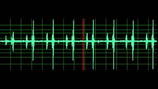 Pulmonary Associated Heart Sounds PAH Split S2 [upl. by Aset]