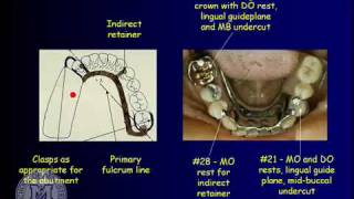 Prosthodontics  Complete Dentures  Vertical Dimension amp Determinants  INBDE ADAT [upl. by Charmaine]