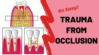 Trauma From Occlusion TFO  PERIODONTOLOGY [upl. by Mckay]