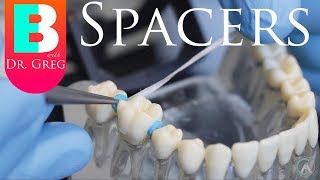 BRACES EXPLAINED Spacers [upl. by Eirrod351]