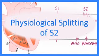 Physiological Splitting of S2 [upl. by Woodford515]