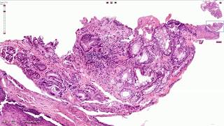 Barrett Esophagus  Histopathology [upl. by Vinaya]