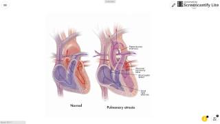 Pulmonary Atresia [upl. by Erdnoed]