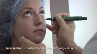 Chirurgie des cernes  Lipostructure du cerne [upl. by Susanetta]