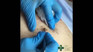 Removal of Seborrheic Keratosis [upl. by Cynthea]