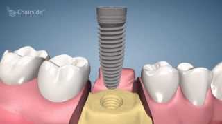 Dental Implant Healing Cap Placement Part 6  Dr John Paul Gallardo  Miami FL [upl. by Wrand]