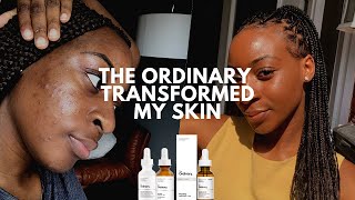 The Ordinary Skin Transformation Mandelic Acid Cleared My Acne  xoreni [upl. by Karoly]