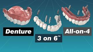 Cleft Palate Complications in Adulthood Fixed by a Prosthodontist [upl. by Naesed]