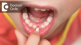 Why do childrens teeth fall out  Dr Raju Srinivas [upl. by Schoenburg]