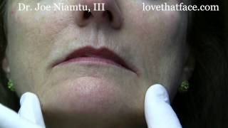 Botox Injection to DAO corner of mouth by Dr Joe Niamtu III [upl. by Attiuqram]