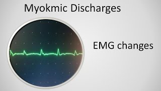 Superior Oblique Myokymia 2 [upl. by Vins448]