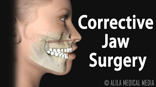 Corrective Jaw Orthognathic Surgery Animation [upl. by Hseyaj]