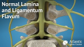 Normal Lamina and Ligamentum Flavum [upl. by Aramoy]