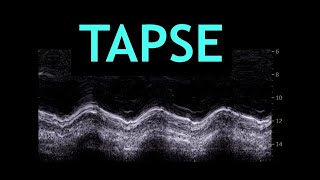 All about TAPSE Echocardiography [upl. by Agarhs]