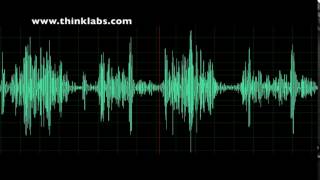 Pulmonary Atresia and BTT Shunt [upl. by Tallbot583]