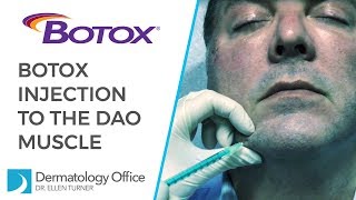 The DAO Muscle  BOTOX® Injections in Dallas [upl. by Noirad]