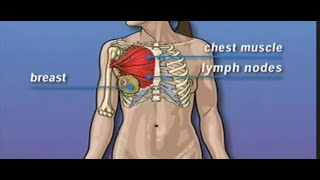 Surgery for Cholesteatoma [upl. by Velda]