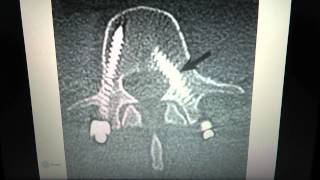 Spinal Implants Pedicle screws [upl. by Dorsy656]