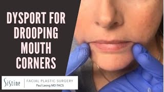 Dysport Injections to DAO Muscle for Drooping Mouth Corners [upl. by Hsekin]