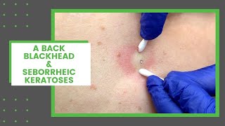 A Back Blackhead amp Seborrheic Keratoses  Dr Derm [upl. by Eimirej871]