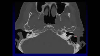 Quick Case  Mastoidectomy [upl. by Atnas]