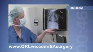 ORLive Express  Esophageal Atresia Surgery [upl. by Elmer]